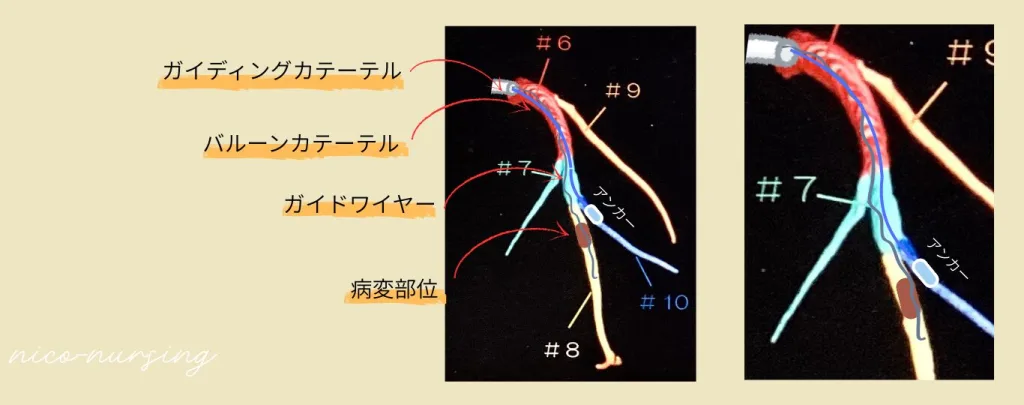 心臓カテーテルにおけるアンカー挿入後のイラスト