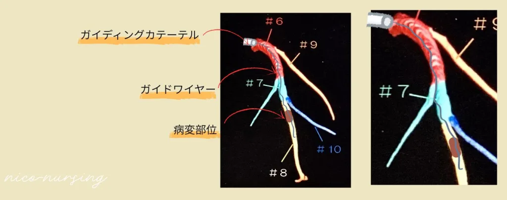 心臓カテーテル、アンカー挿入前のイラスト