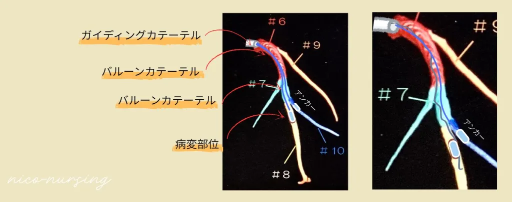 心臓カテーテルにおけるアンカー挿入後の治療イメージ画像