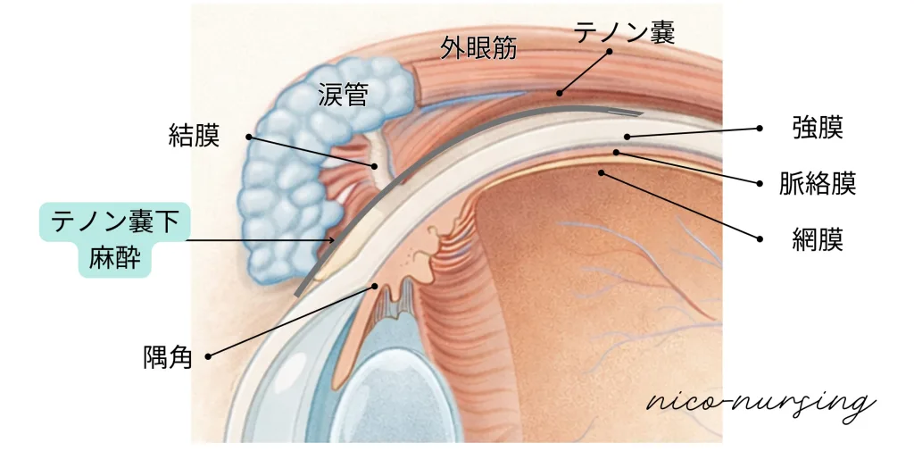 テノン嚢下麻酔